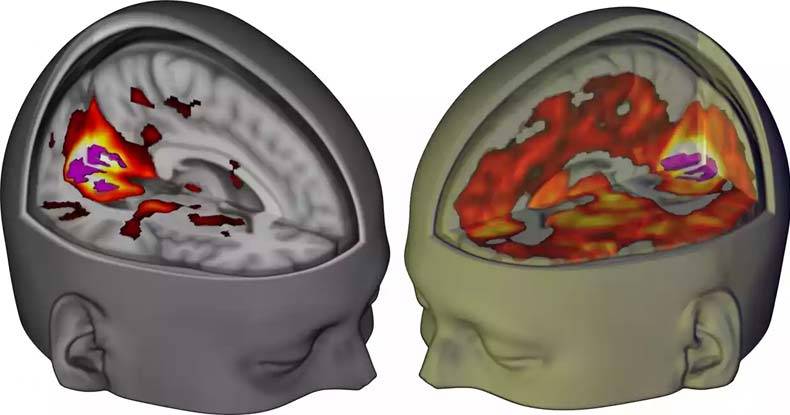 lsd-brain-1